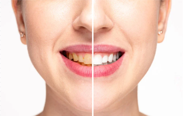 Clareamento Dental — Seu sorriso mais branco e saudável