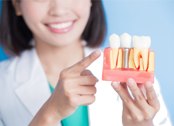 Implantodontia — Sorria com segurança novamente